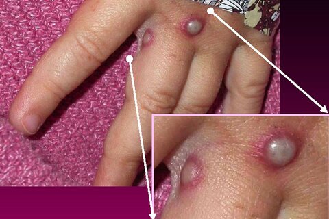 علائم آبله میمونی تا ۴ هفته بهبود می‌یابد/انتقال بیماری از برخورد پوستی